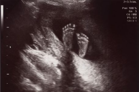 De ce nu se mai fac avorturi la cerere în Spitalul Județean de Urgență Piatra-Neamț